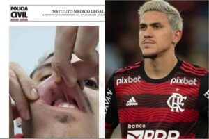 Pedro será punido no Flamengo após levar soco em BH, contra o Atlético