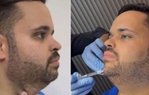 De BH, ex-BBB Michel faz harmonização facial com lipo de papada