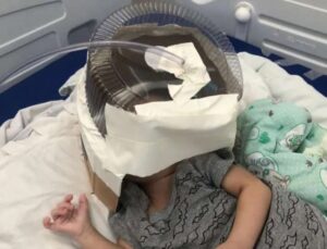 Bebê que usou capacete de oxigênio feito com embalagem de bolo deixa UTI