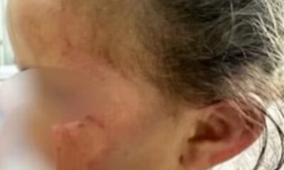 Rosto de uma menina pequena com marcas visíveis de agressão na bochecha e orelha, usando roupa hospitalar, com o rosto parcialmente desfocado para preservar a identidade.