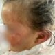 Rosto de uma menina pequena com marcas visíveis de agressão na bochecha e orelha, usando roupa hospitalar, com o rosto parcialmente desfocado para preservar a identidade.