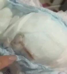 Foto mostra parte interna de uma fralda com uma área escurecida e suspeita, onde foi identificado um roedor morto, segundo relato da mãe.