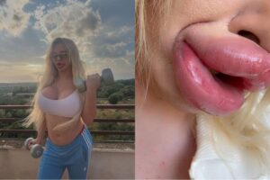 Jovem gasta R$1 mi em estética e perde mobilidade dos lábios