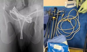 Radiografia de pelve exibindo cabo USB enrolado dentro da bexiga; ao lado, foto de instrumentos cirúrgicos e o cabo removido, disposto sobre mesa cirúrgica azul