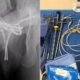 Radiografia de pelve exibindo cabo USB enrolado dentro da bexiga; ao lado, foto de instrumentos cirúrgicos e o cabo removido, disposto sobre mesa cirúrgica azul