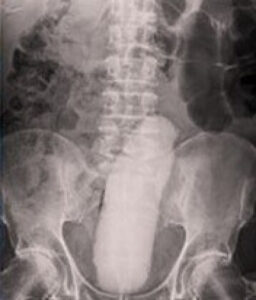 Raio-X abdominal revela objeto alongado e opaco localizado no reto de um paciente, entre a coluna lombar e a pelve.