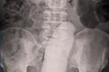Raio-X abdominal revela objeto alongado e opaco localizado no reto de um paciente, entre a coluna lombar e a pelve.