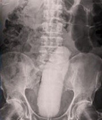 Raio-X abdominal revela objeto alongado e opaco localizado no reto de um paciente, entre a coluna lombar e a pelve.