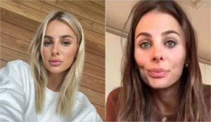 Antes e depois do nariz da influenciadora