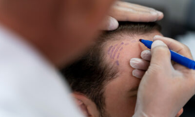 Médico desenhando em cabeça de paciente para transplante