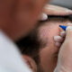 Médico desenhando em cabeça de paciente para transplante