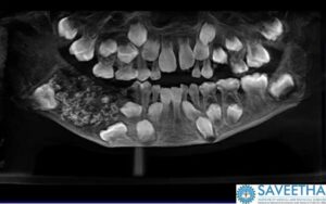 Raio x mostram 526 dentes na boca de criança