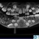 Raio x mostram 526 dentes na boca de criança