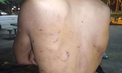 costas com machucados