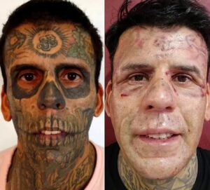 O homem mais tatuado do Brasil exibe resultado impressionante após remover desenhos do rosto; veja antes e depois
