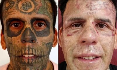 O homem mais tatuado do Brasil exibe resultado impressionante após remover desenhos do rosto; veja antes e depois