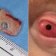 Dente vira janela para enxergar novamente