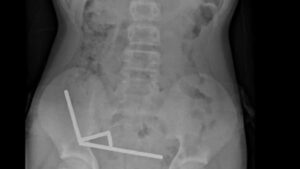 Cirurgia remove ímãs e parte do intestino de criança na Nova Zelândia