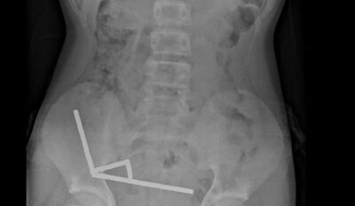 Cirurgia remove ímãs e parte do intestino de criança na Nova Zelândia