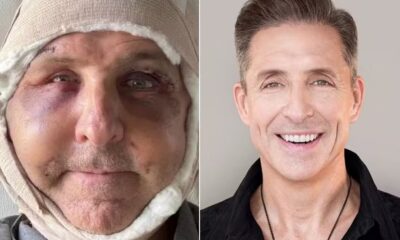 Dave Asprey exibe o resultado de procedimento estético com células-tronco aplicadas no rosto para retardar sinais de envelhecimento