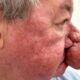 Escocês volta a beijar esposa após cirurgia no nariz; veja antes e depois