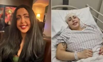 Hannah Roper, de 24 anos, precisou passar por cirurgias delicadas após queda em escada