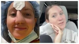 Três anos após ataque de cão, mulher revela reconstrução do nariz após 16 cirurgias