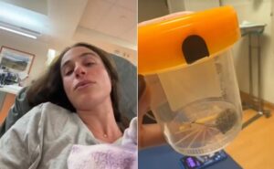 Mulher descobre bola de pelos envolvendo DIU após sofrer com dor e infecções